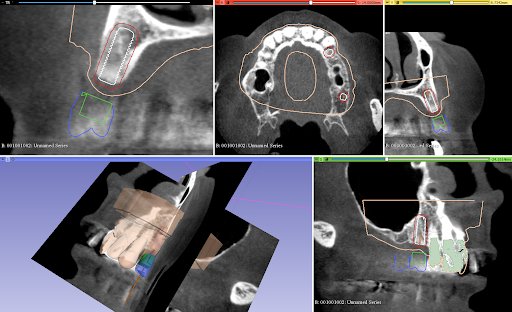 Using Surgical Guide Resin for Implant Placement In a Partial ...